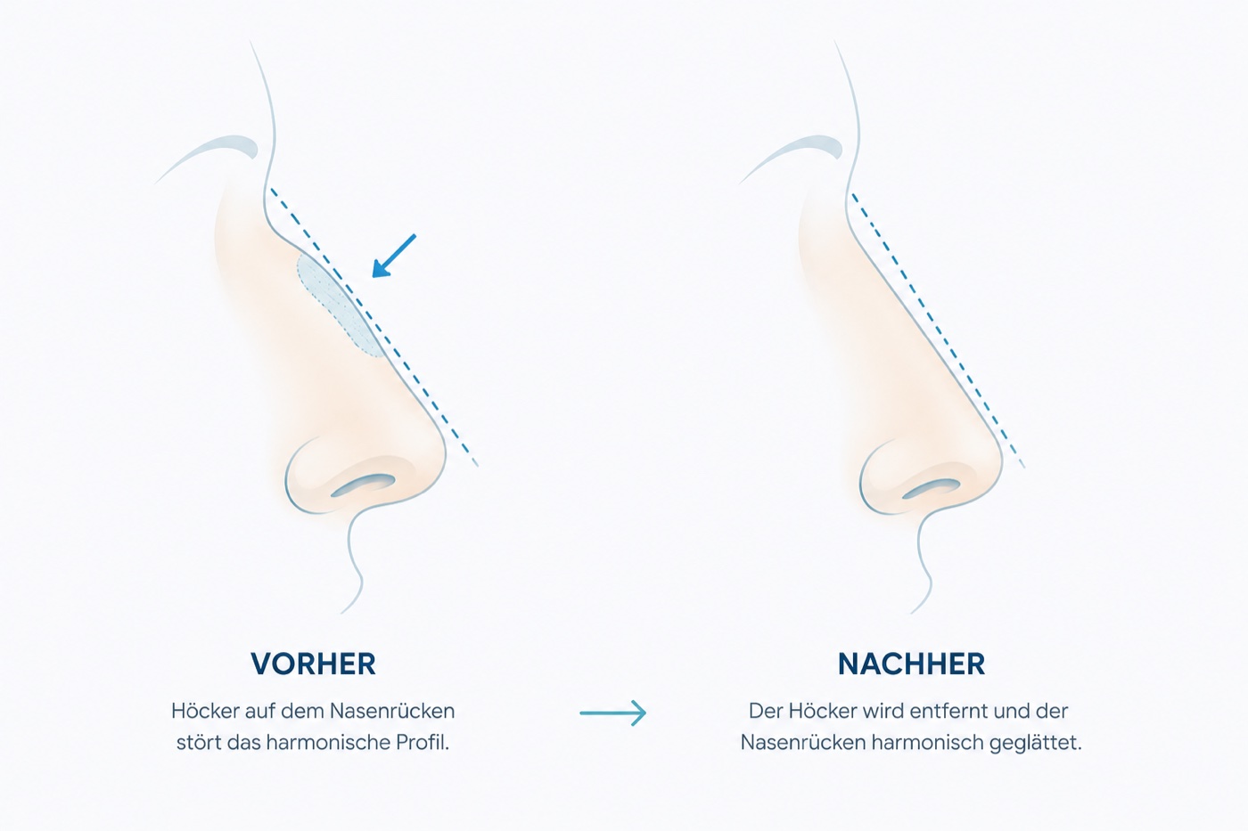 Nasenflügel verkleinern Rosenheim — Vorher Nachher